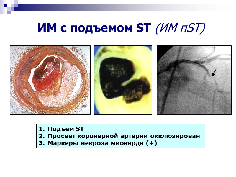 ИМ с подъемом ST (ИМ пST) Подъем ST Просвет коронарной артерии окклюзирован Маркеры некроза